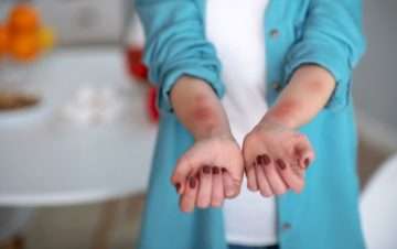 Woman in teal shirt having allergic reaction on her forearms.
